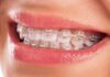 Can Insurance Cover Braces