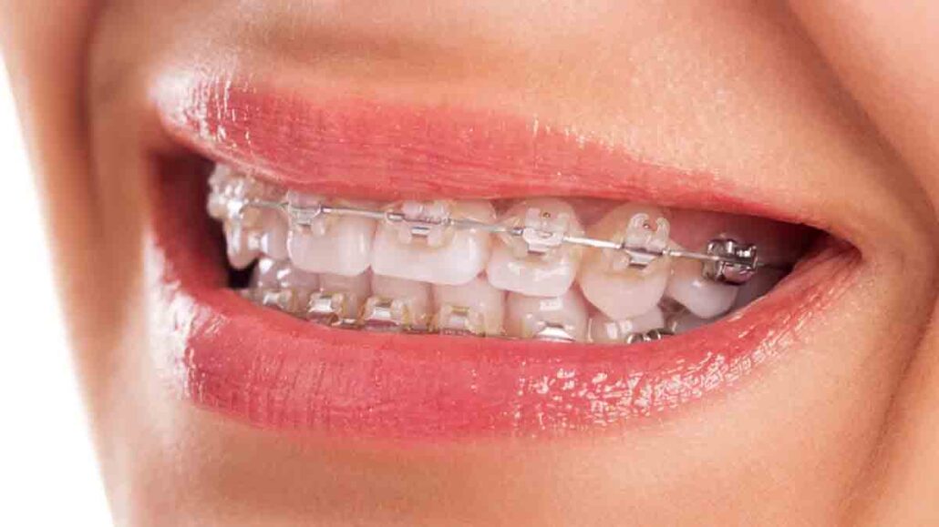 Can Insurance Cover Braces