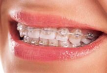 Can Insurance Cover Braces