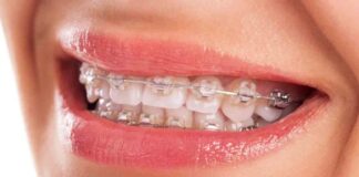 Can Insurance Cover Braces